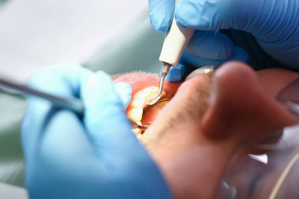 Best Emergency Tooth Extraction in Richton, MS