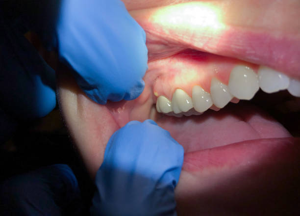 Best Emergency Wisdom Teeth Removal in Richton, MS